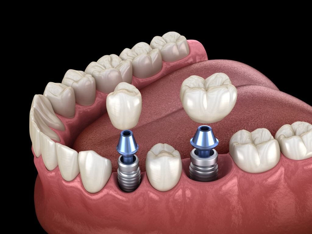 The Art of Seamless Integration: How Dental Implants Blend with Natural Teeth